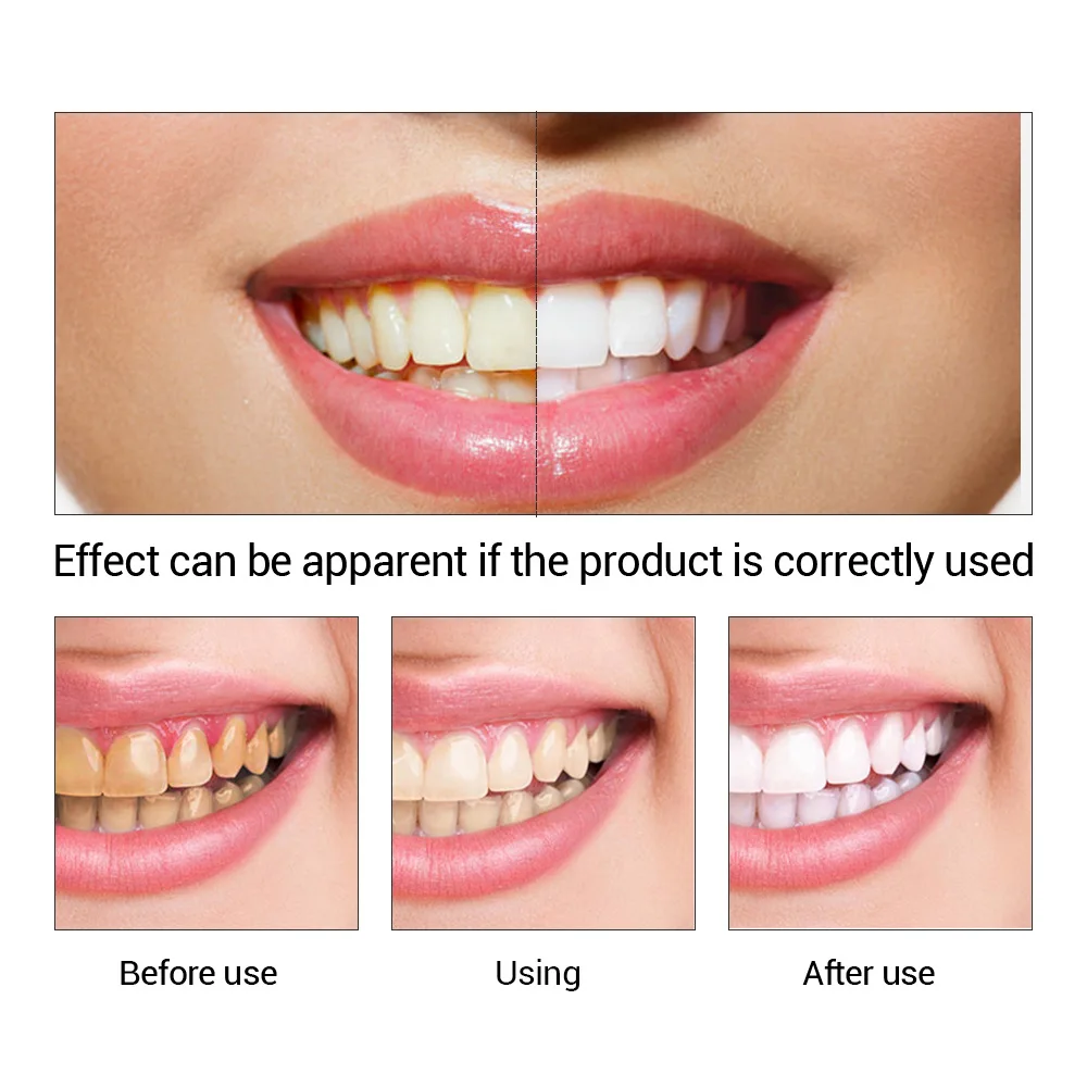 FTEENPLY poudre d'essence de b - Teeth Whitening Clinic avis et prix